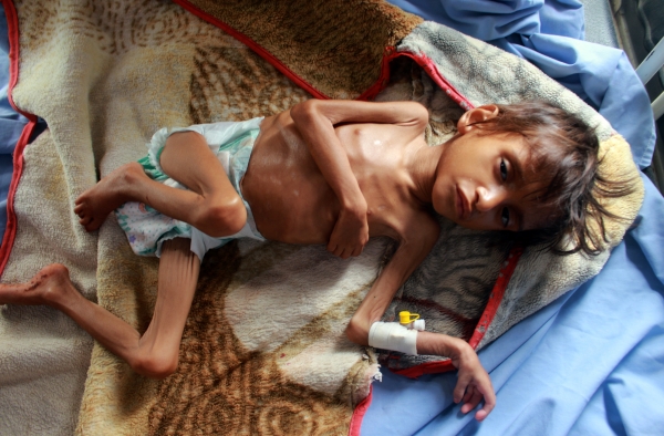 "أطفال اليمن"… أجساد هزيلة شاهدة على سنوات الحرب الدمار (تقرير)