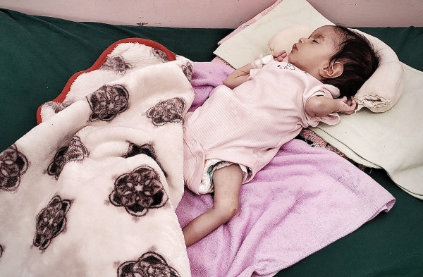 الصحة العالمية: 3 من كل 4 أربعة أطفال في اليمن يعانون سوء التغذية